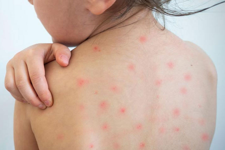 হামে আরও ২ শিশুর মৃত্যু