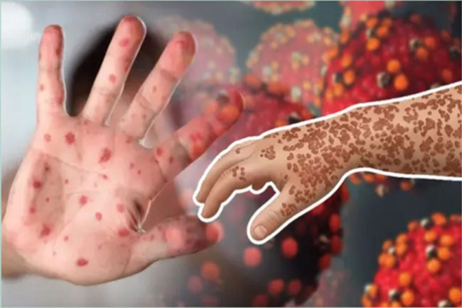 হাম পরিস্থিতি ভয়াবহ, শিশু মৃত্যু ২৫০ ছাড়াল