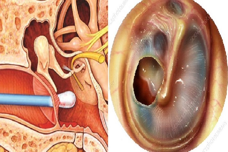 কানের পর্দা ফেটে যাওয়ার চিকিৎসা