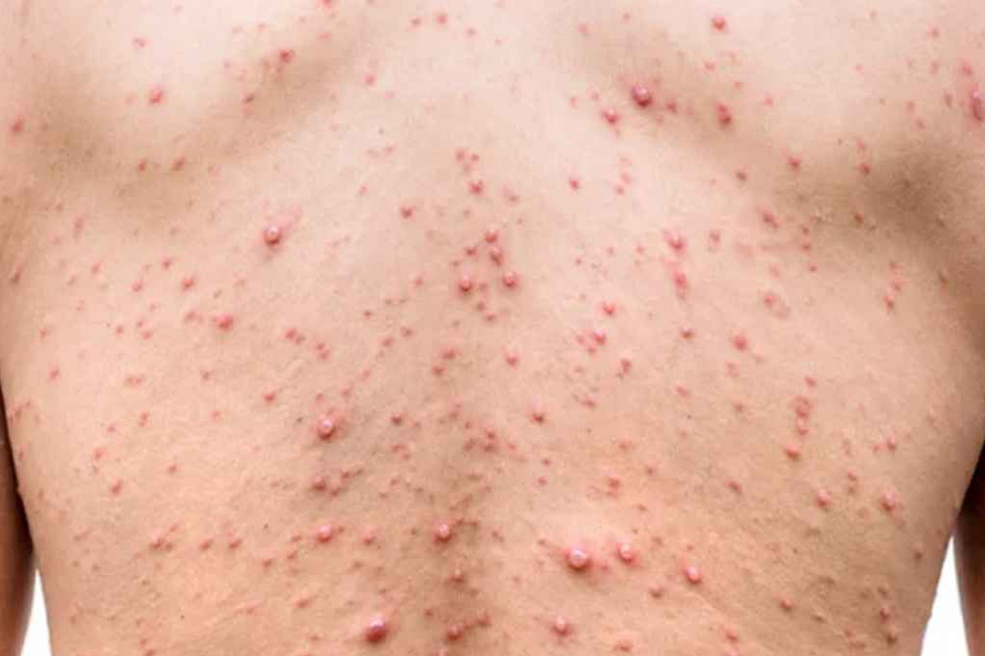 হাম ও হামের উপসর্গ নিয়ে আরও ৮ শিশুর মৃত্যু