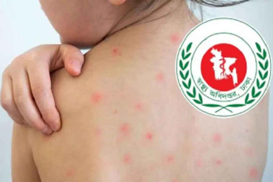 হামের উপসর্গে দেশে আরও ৪ শিশুর মৃত্যু