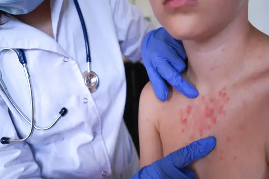 ২৪ ঘণ্টায় হামের লক্ষণে মৃত্যু ৪, আক্রান্ত ১৬৮