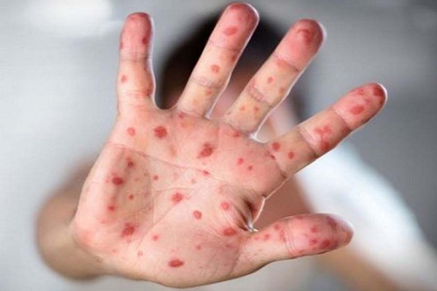 ১৯ দিনে হাম সন্দেহে ভর্তি ৯৪ শিশুর মৃত্যু