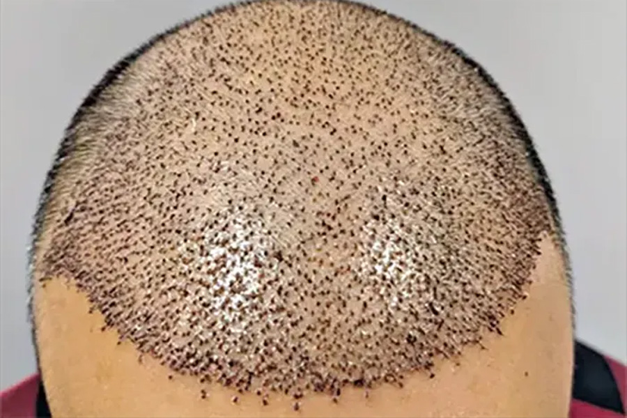 চুল প্রতিস্থাপনের পর হতে পারে যেসব সমস্যা