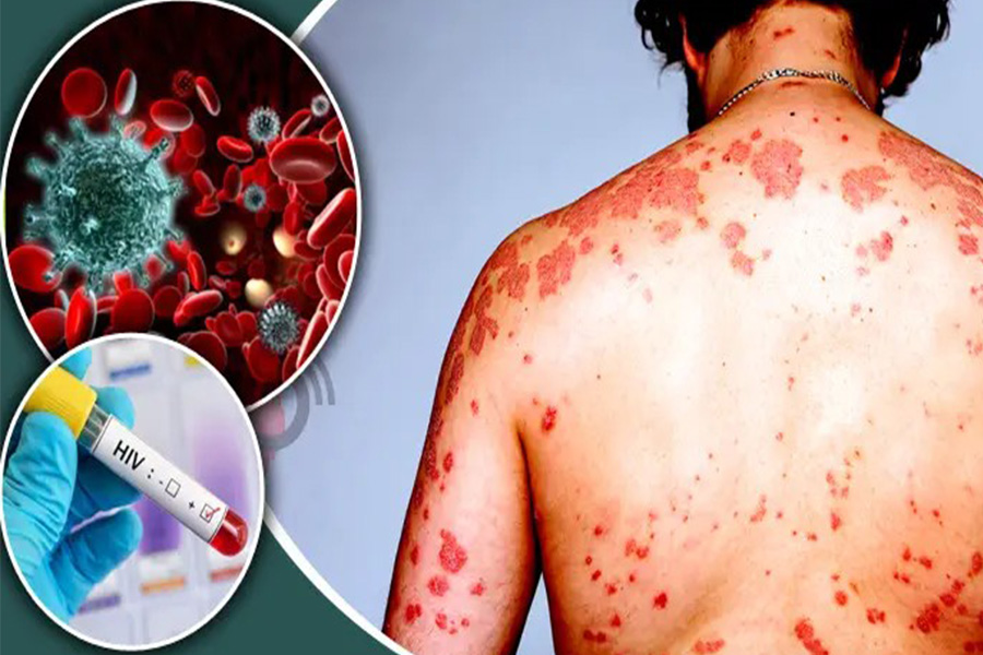 রাজশাহীতে বাড়ছে এইডস রোগীর সংখ্যা