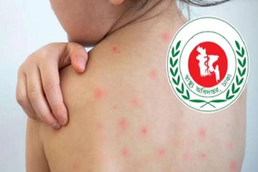 ক্রমেই বাড়ছে হামে আক্রান্ত, আরও ৮ মৃত্যু