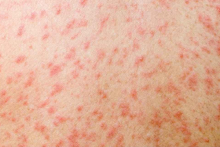 হাম ও হামের উপসর্গে সাত জনের মৃত্যু, নতুন রোগী ১৪ শতাধিক