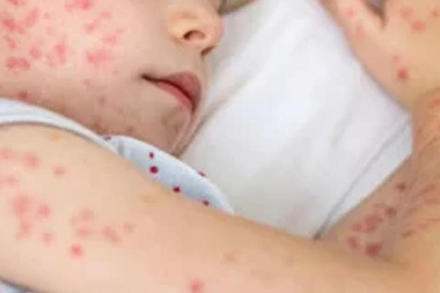 একদিনে হাম ও উপসর্গ নিয়ে আরও ১১ জনের মৃত্যু