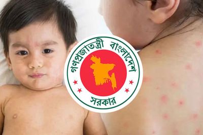 হাম ও উপসর্গে আরও ৬ শিশুর মৃত্যু