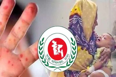 হামের উপসর্গে আরও ৭ শিশুর মৃত্যু, প্রাণহানি ছাড়াল ৬শ’
