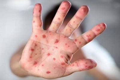 ১৯ দিনে হাম সন্দেহে ভর্তি ৯৪ শিশুর মৃত্যু