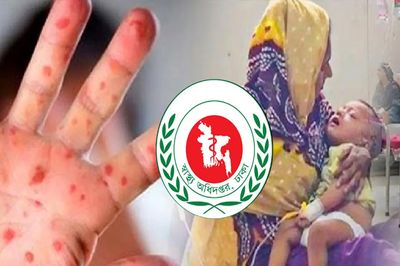 ২৪ ঘণ্টায় হাম ও উপসর্গে ৭ শিশুর মৃত্যু