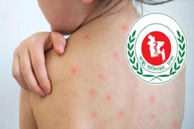 ক্রমেই বাড়ছে হামে আক্রান্ত, আরও ৮ মৃত্যু