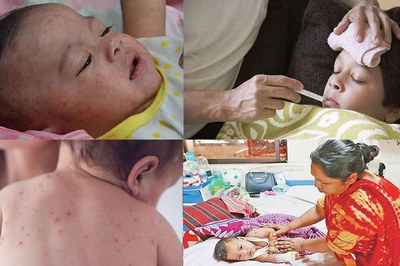 হাম কেন হয়, কিভাবে ছড়ায় এবং প্রতিরোধের উপায় কি?