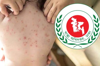 হামের উপসর্গ নিয়ে আরও ১০ মৃত্যু